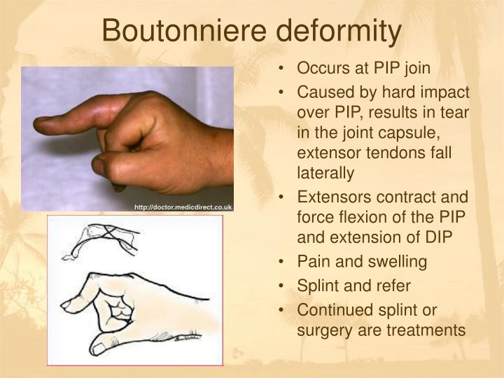 ppt chapter 12 wrist and hand injuries powerpoint boutonniere deformity