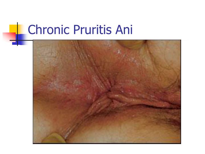 Constant anal itching