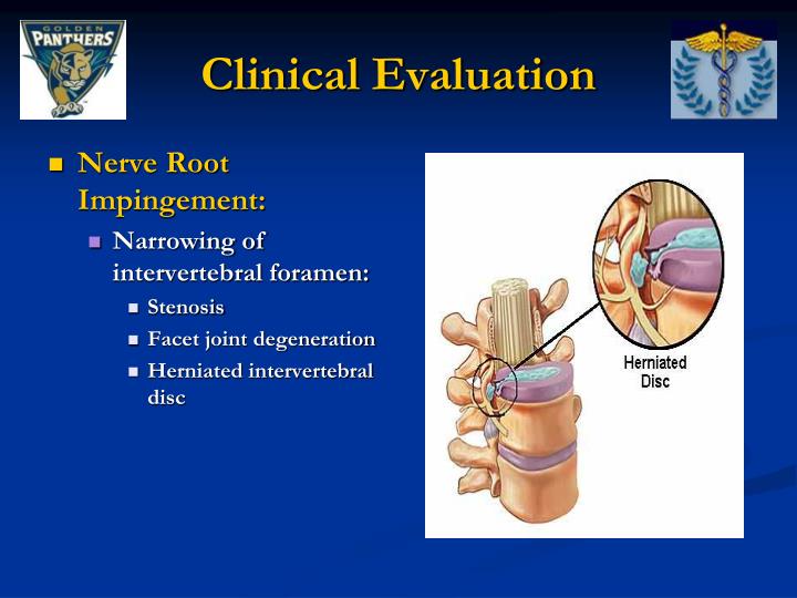 What Is Nerve Root Impingement