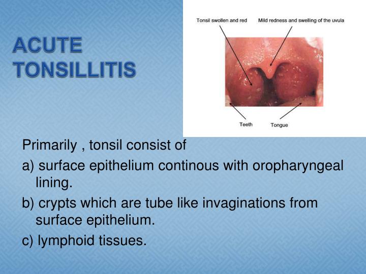 Ppt Acute And Chronic Tonsilitis Powerpoint Presentation Id1290581