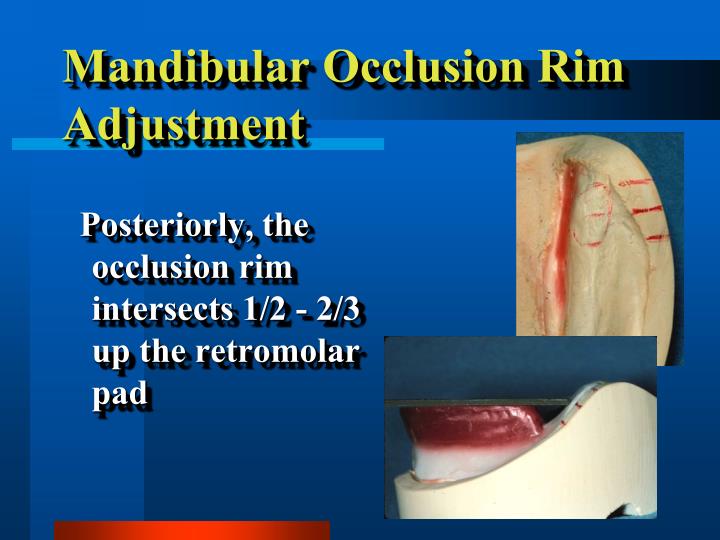 PPT Record Bases & Occlusion Rims PowerPoint Presentation ID1444831