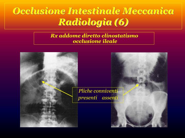 Differenza Tra Occlusione E Subocclusione Intestinale PPT - Occlusioni PowerPoint Presentation - ID:1474262