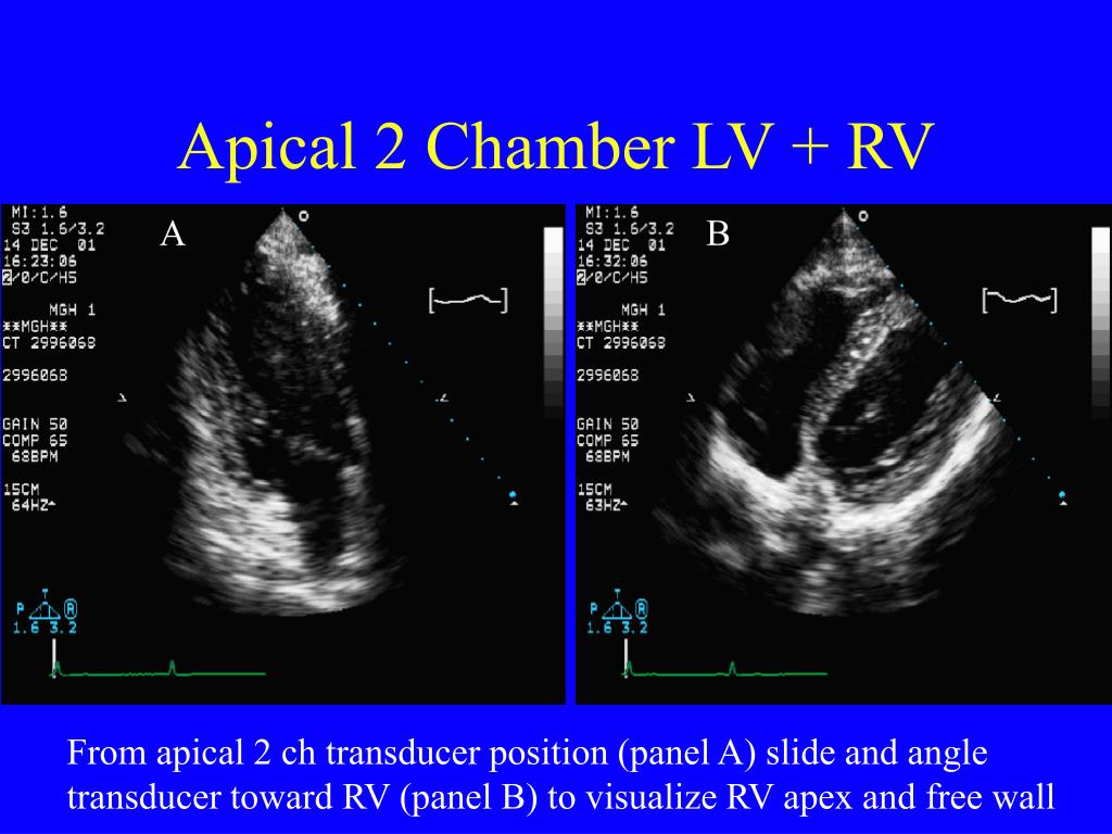 PPT - Echocardiographic Exam for ARVD PowerPoint Presentation - ID:154715
