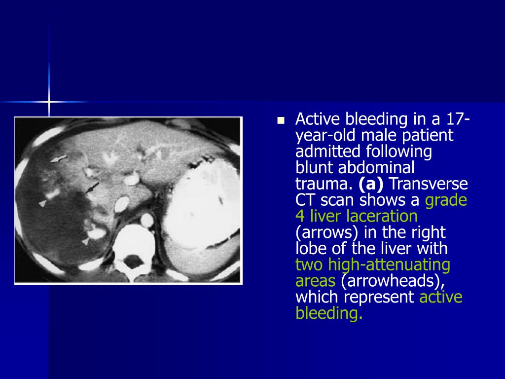 Blunt injury abdomen dissertation