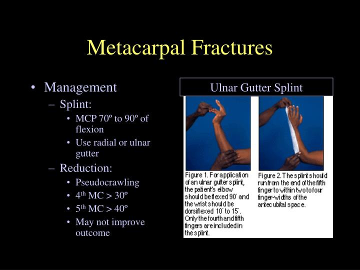 3rd metacarpal fracture splint 3rd metacarpal fracture splint