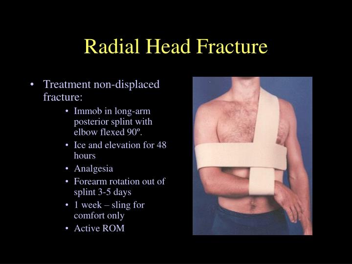 non displaced radial head fracture non displaced radial head fracture
