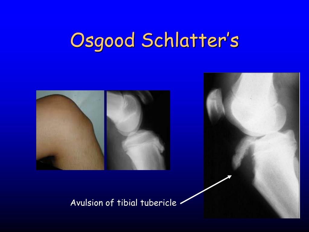 what is schlatters disease