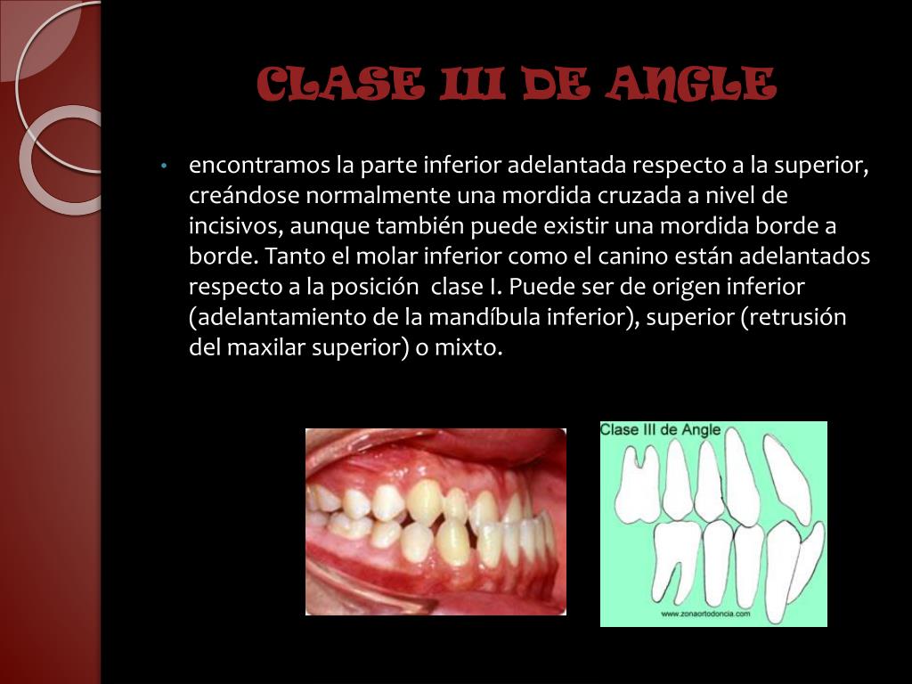Ppt Maloclusiones Clase Iii Powerpoint Presentation Id195808