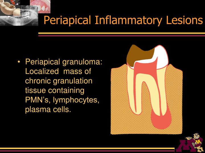 inflammatory lesions #11