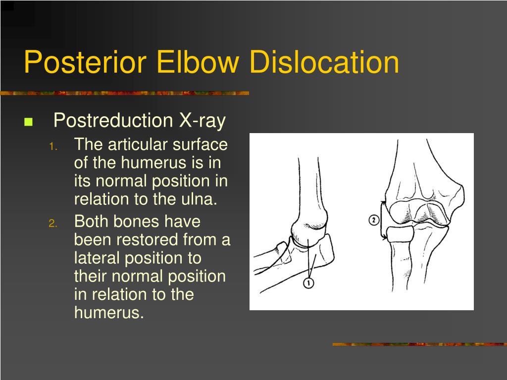 PPT - Dislocation and Fracture Reductions PowerPoint ...