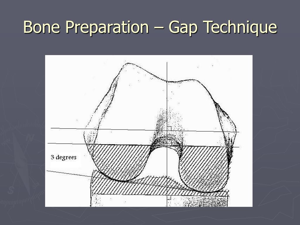PPT Total Knee Arthroplasty PowerPoint Presentation ID265534