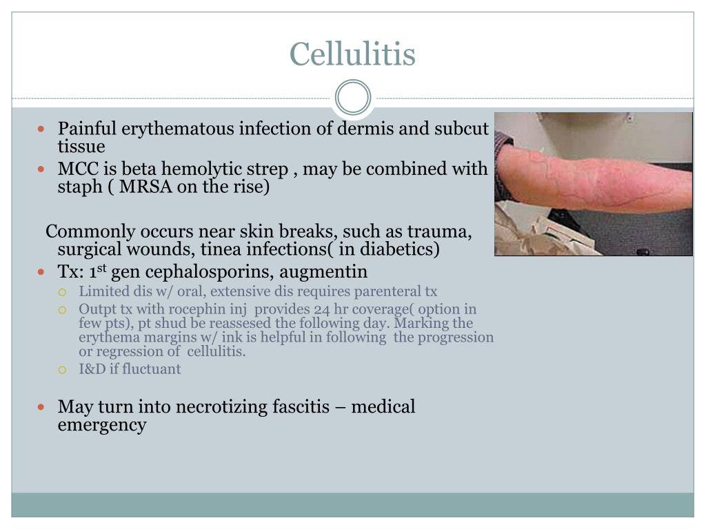 does bactrim cover cellulitis