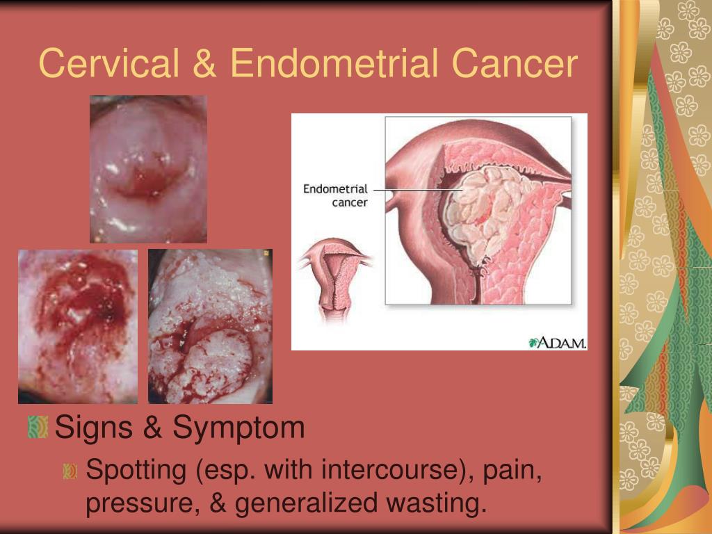 signs and symptoms cervical cancer has lower back