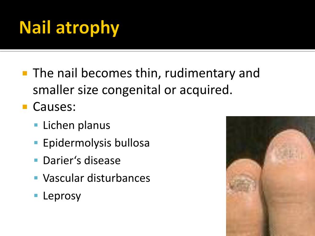 PPT - Nail Disorders: Clues to Systemic Disease PowerPoint Presentation
