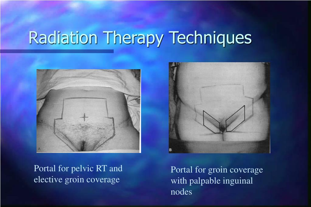 PPT Vaginal Cancer PowerPoint Presentation ID 303038 side-effects-of-radiation-for-breast-cancer-what-to-know