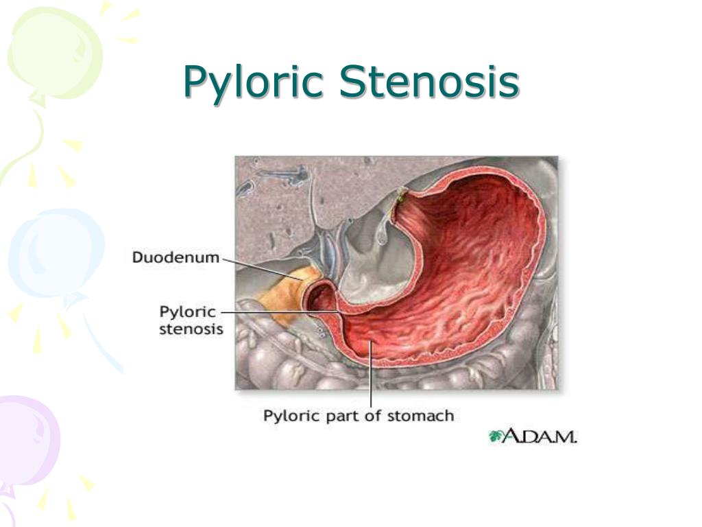 Adult In Pyloric Stenosis Bare Photograph