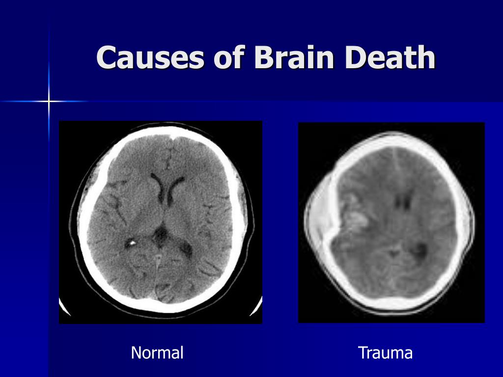 PPT - Brain Death Anatomy and Physiology PowerPoint Presentation - ID