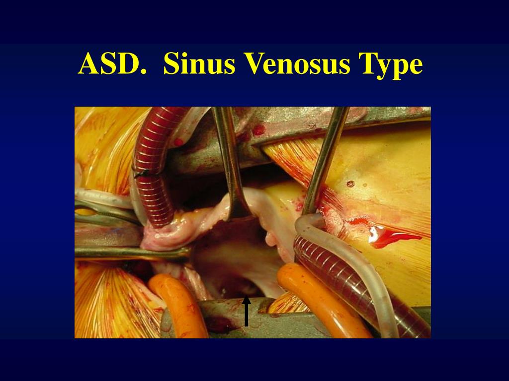 PPT - Atrial Septal Defect PowerPoint Presentation - ID:354587
 Sinus Venosus Asd