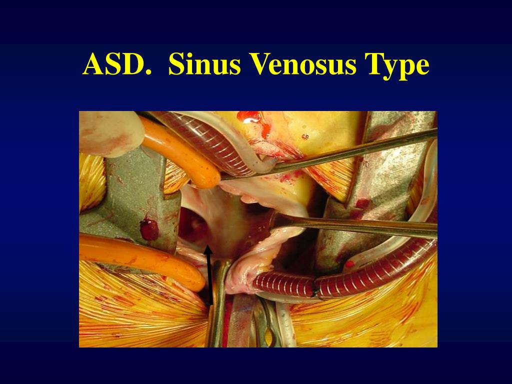 PPT - Atrial Septal Defect PowerPoint Presentation - ID:354587
 Sinus Venosus Asd