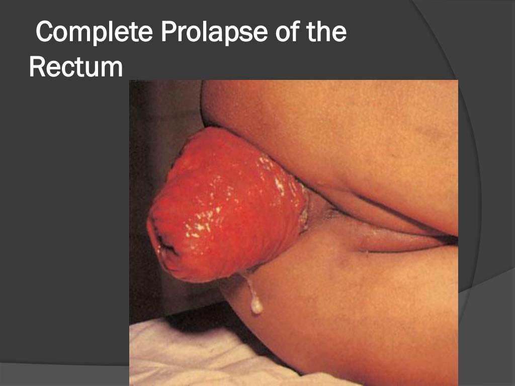 christa b allen naked prolapsing through anus