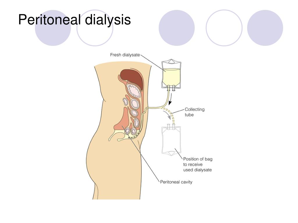 hemodialysis and peritoneal dialysis pdf