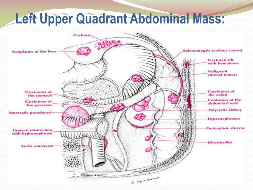 PPT Left Upper Quadrant Pain And Masses PowerPoint Presentation ID 