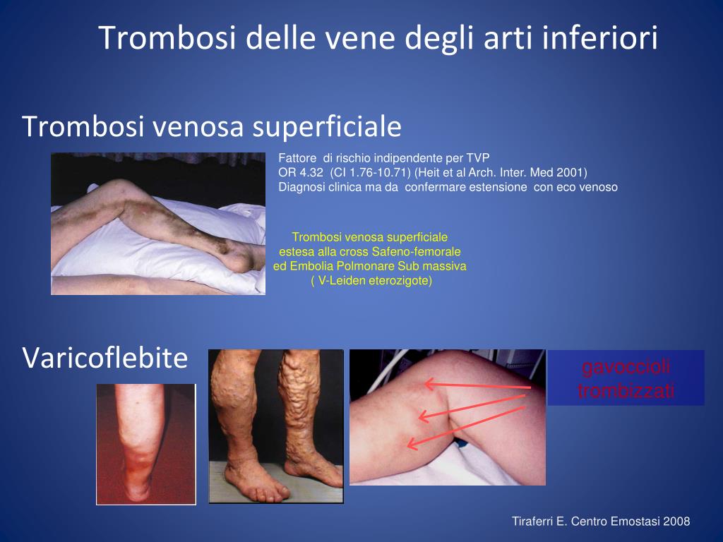 Se è possibile fare avvolgere con argilla a varicosity