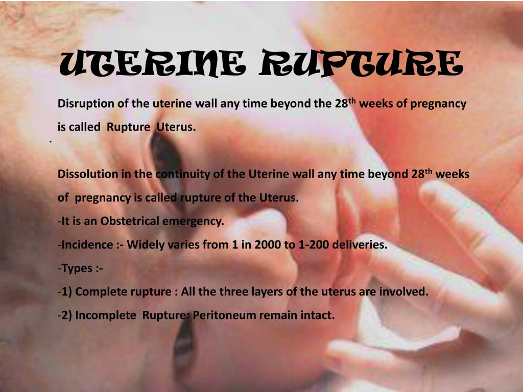 ppt-uterine-rupture-powerpoint-presentation-id-506056