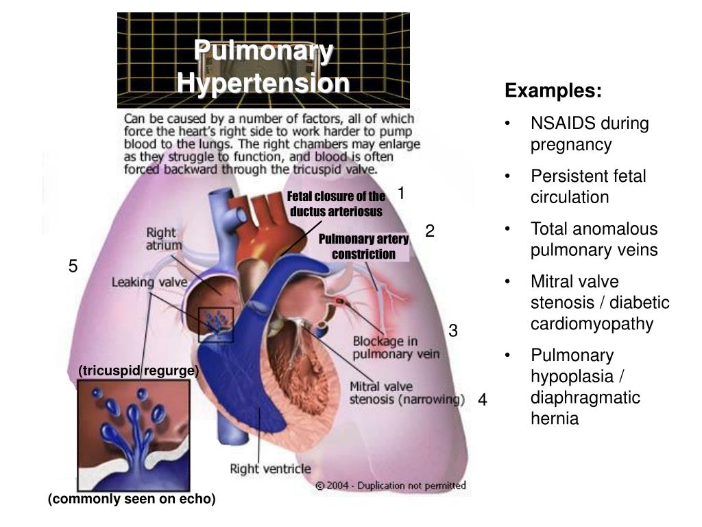 PPT Persistent Pulmonary Hypertension in the Newborn PowerPoint