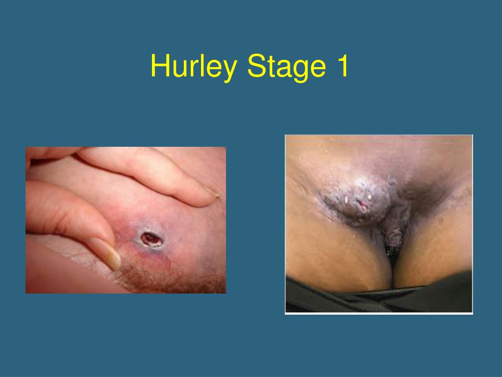 Abscess Causes Symptoms Tests and Treatment