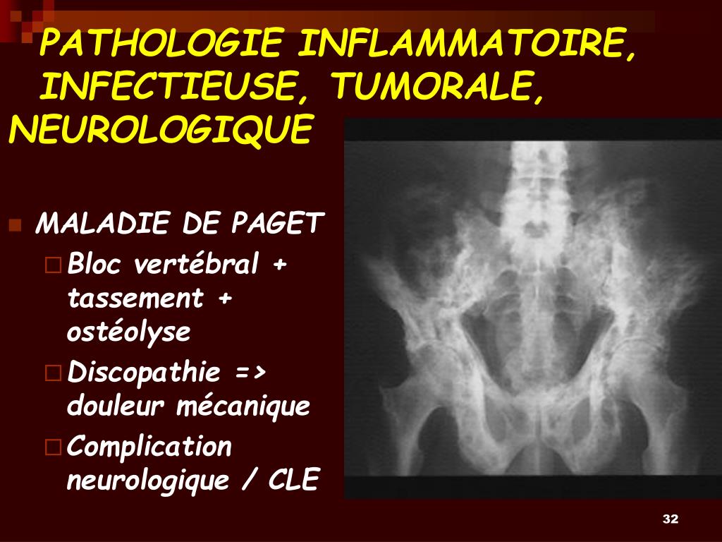 PPT  LES LOMBALGIES DE LA PERSONNE AGEE PowerPoint Presentation  ID