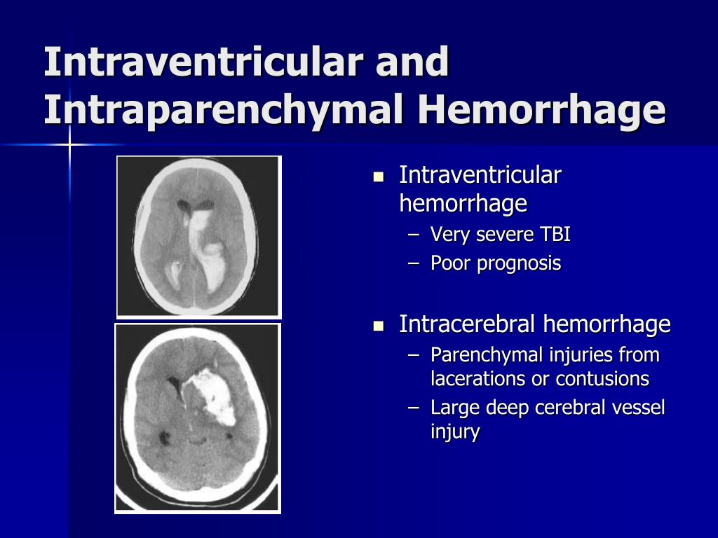 Deep Intracerebral Hemorrhage Pictures