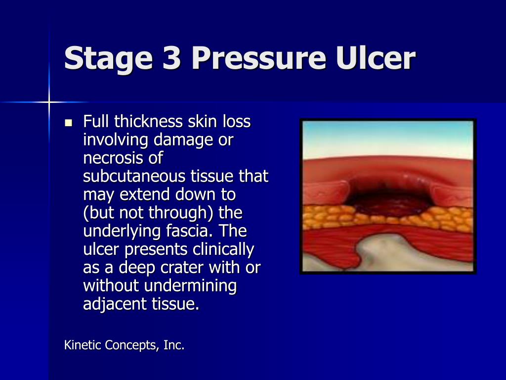 PPT - VACUUM ASSISTED CLOSURE (V.A.C.) THERAPY: An Advanced System for