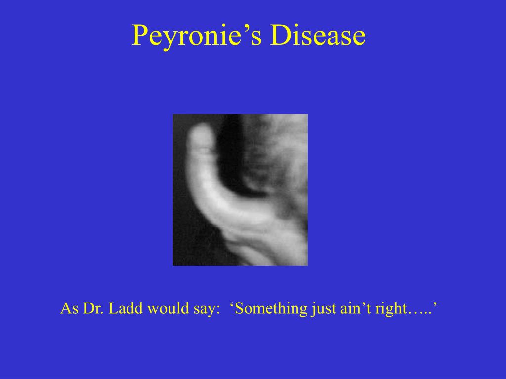 Peyronie Disease Images 