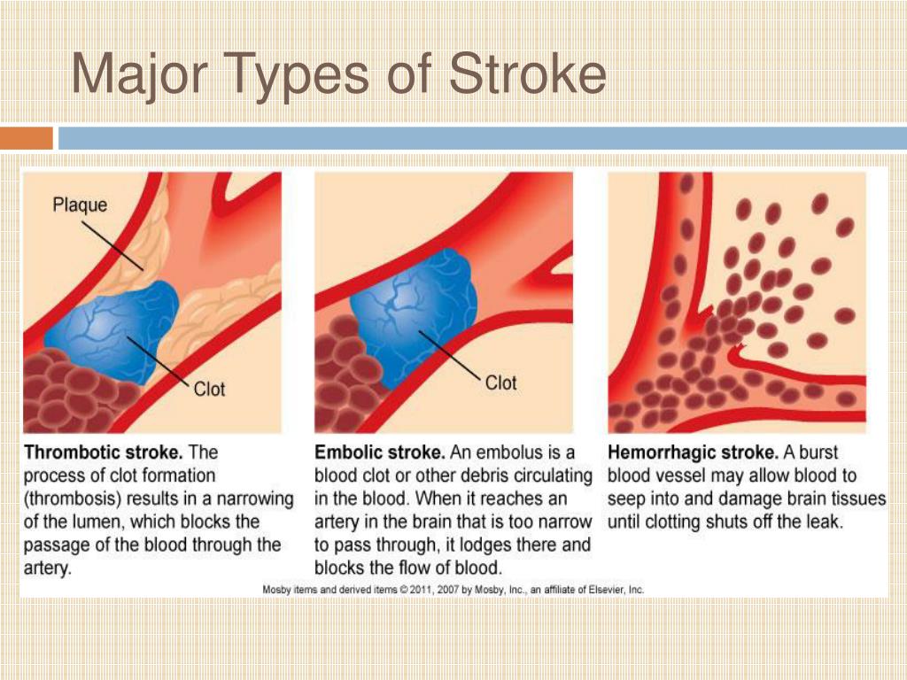 ppt-stroke-nursing-management-powerpoint-presentation-id-751804