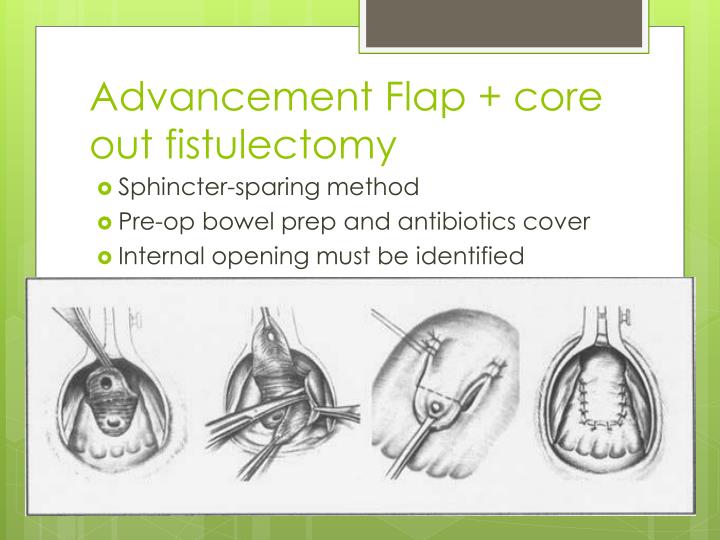PPT The Best Surgical Treatment For Fistula in ano PowerPoint ppt-the-best-surgical-treatment-for-fistula-in-ano-powerpoint
