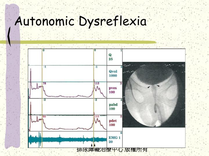 autonomic dysreflexia Autonomic dysreflexia a guide to acute nursing care prevention, and education. autonomic dysreflexia Autonomic dysreflexia a guide to acute nursing care prevention, and education.