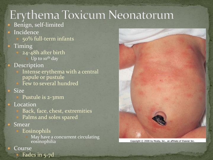 Erythema Toxicum Neonatorum Pictures Symptoms Causes Treatment My Xxx Hot Girl