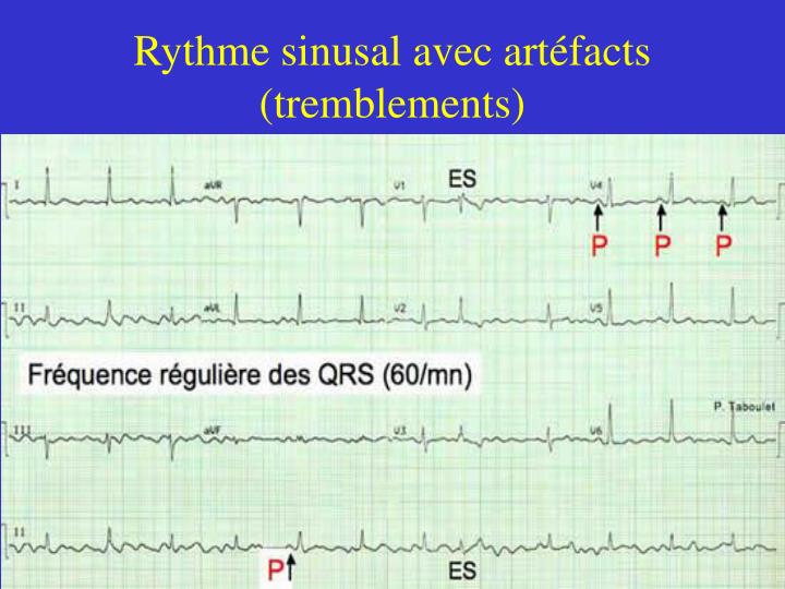 Comme insensibiliser de poitrine osteokhondroz