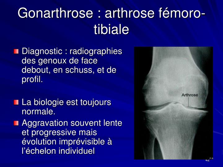gonarthrose femoro tibiale gonarthrose femoro tibiale