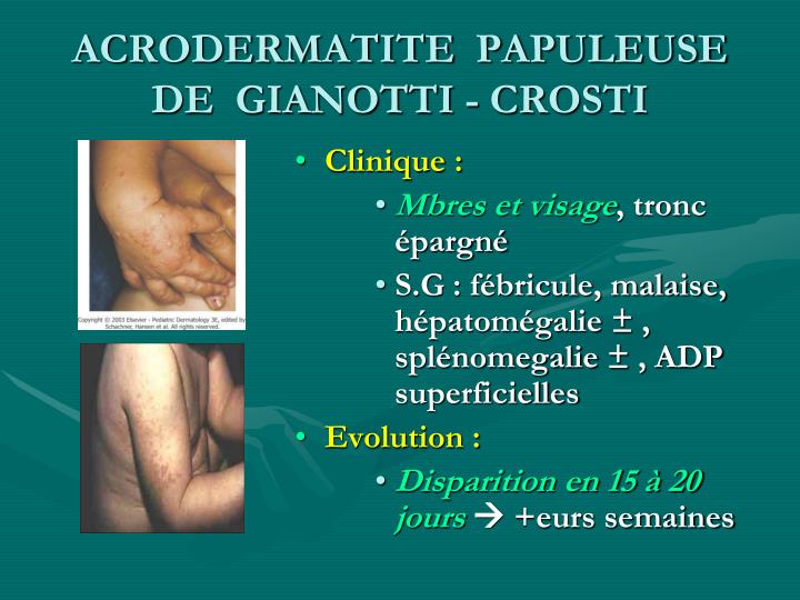Acrodermatite Papuleuse Infantile De Gianotti Crosti PPT - VIROSES A EXPRESSION CUTANÉE Dr L. TAIBI / DERMATOLOGIE CHU
