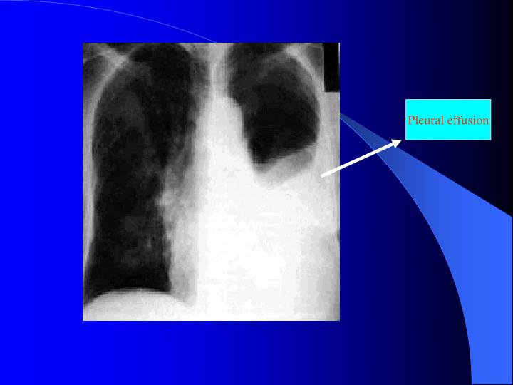 rales lung sounds pleural effusion rales lung sounds pleural effusion