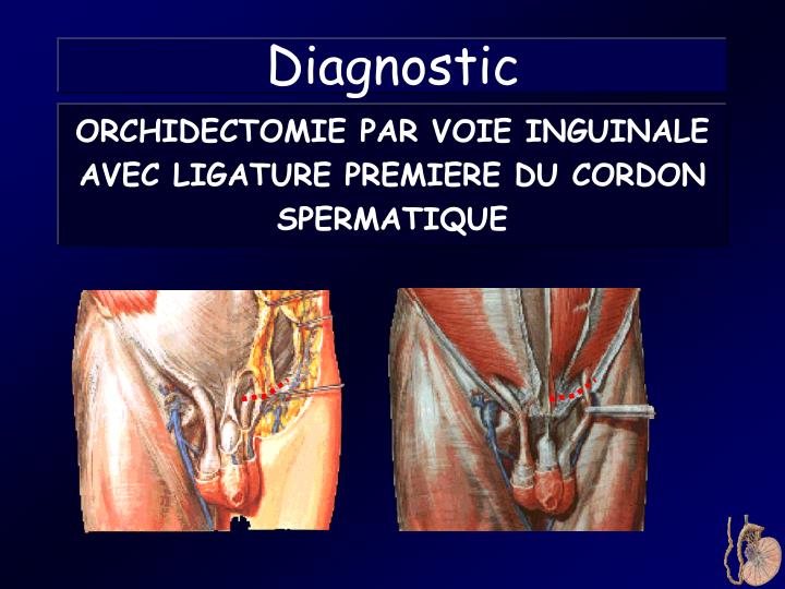 traitement most cancers prostate metastase