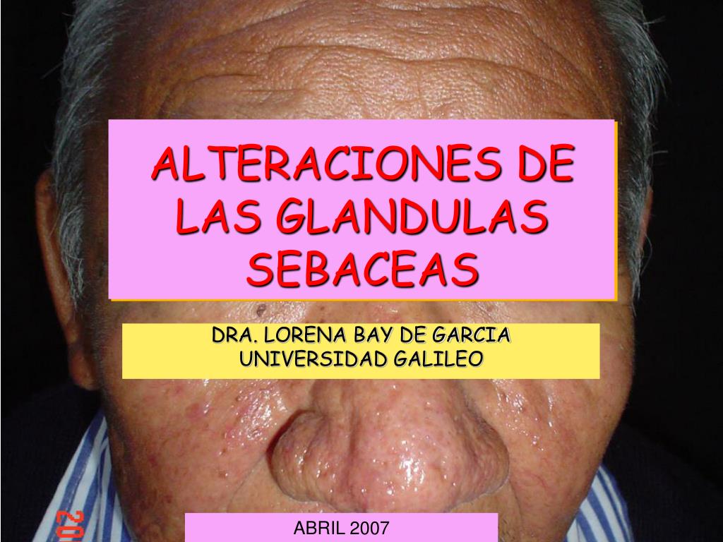PPT - ALTERACIONES DE LAS GLANDULAS SEBACEAS PowerPoint Presentation, free  download - ID:1001879