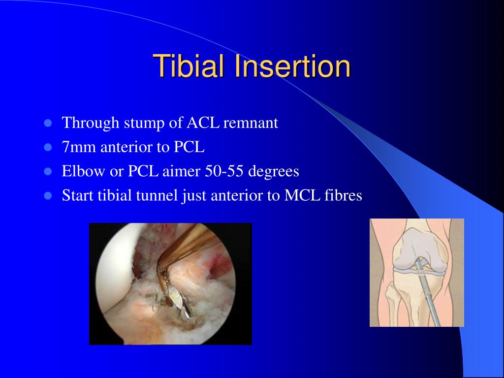 Tibial anterior ejercicios