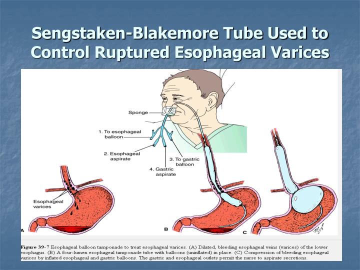 sengstaken blakemore tube nursing care balloon tamponade sengstaken blakemore tube