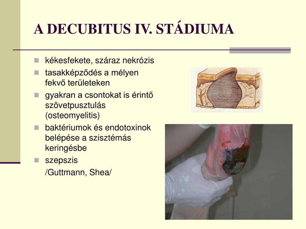 decubitus