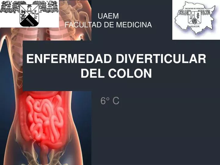 enfermedad diverticular de colon sigmoides no complicada enfermedad diverticular de colon sigmoides no complicada