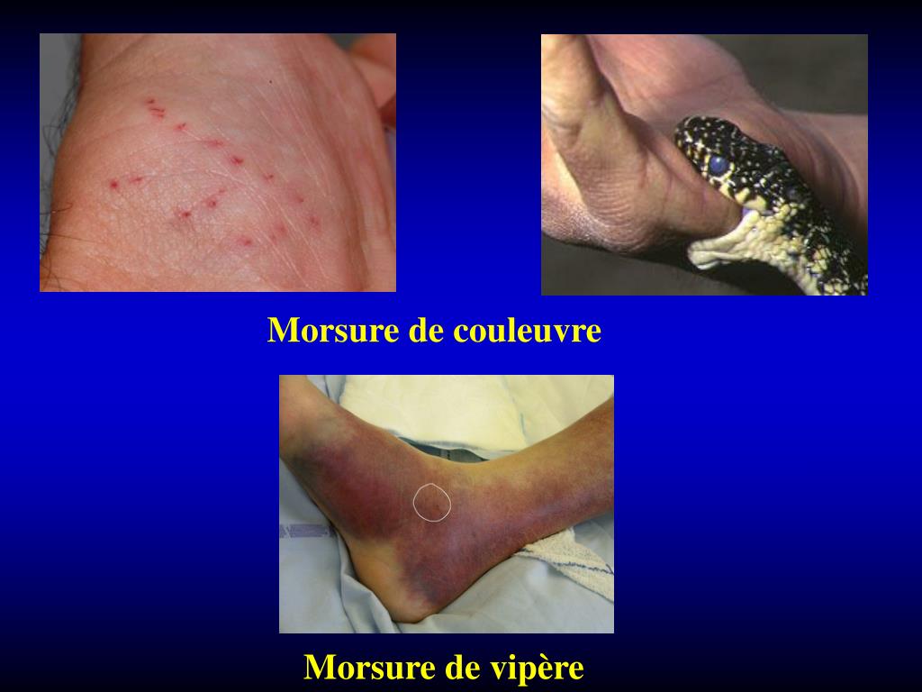 PPT Morsure De Serpent PowerPoint Presentation Free Download ID PPT Morsure De Serpent PowerPoint Presentation Free Download ID