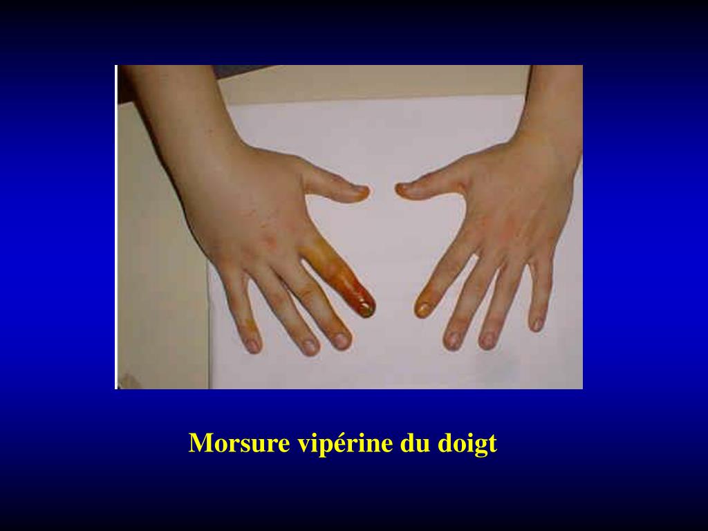 PPT Morsure De Serpent PowerPoint Presentation Free Download ID PPT Morsure De Serpent PowerPoint Presentation Free Download ID